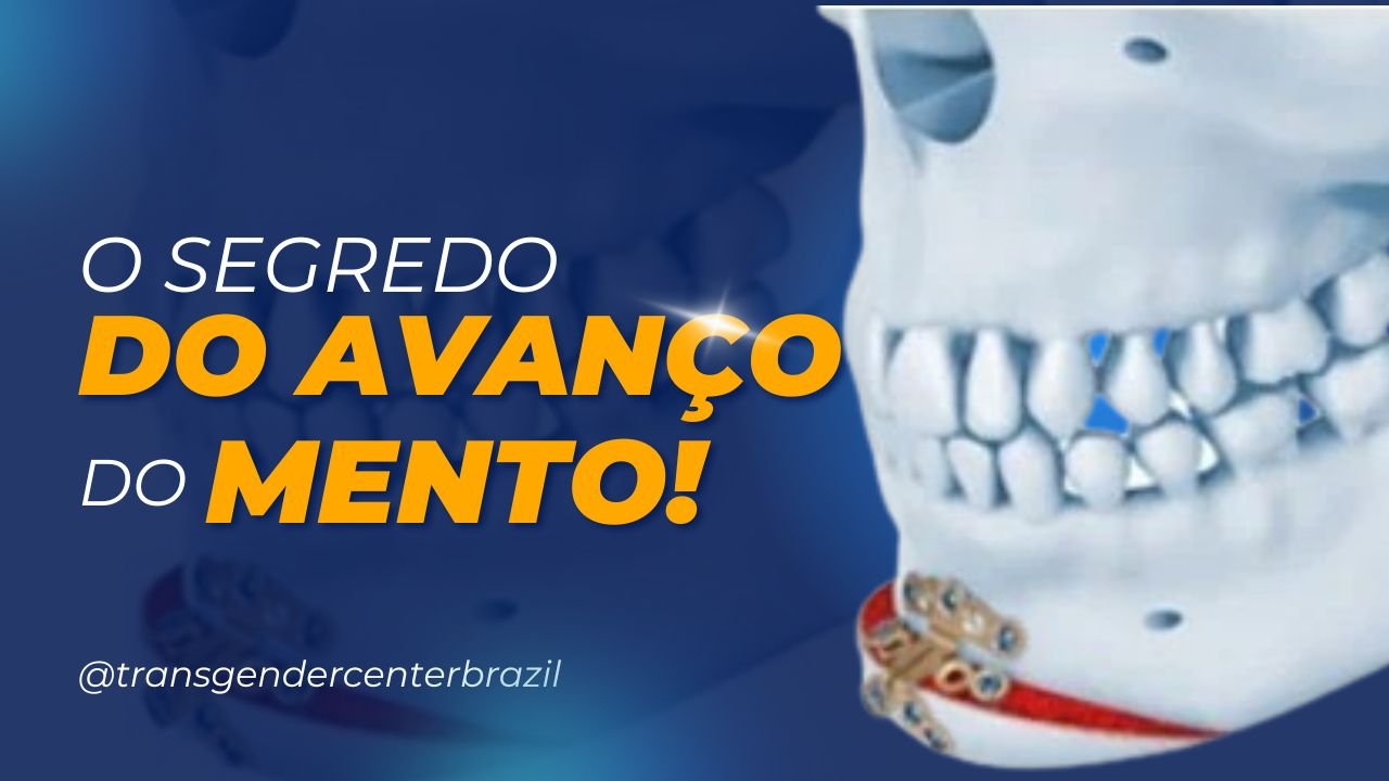 Avanço de Mento: A Cirurgia que transforma seu rosto sem implantes